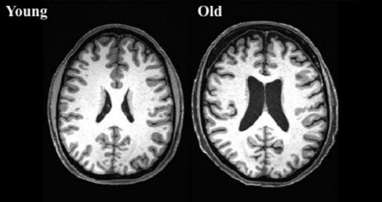How does a 70 year old brain differ from a 17 year old brain